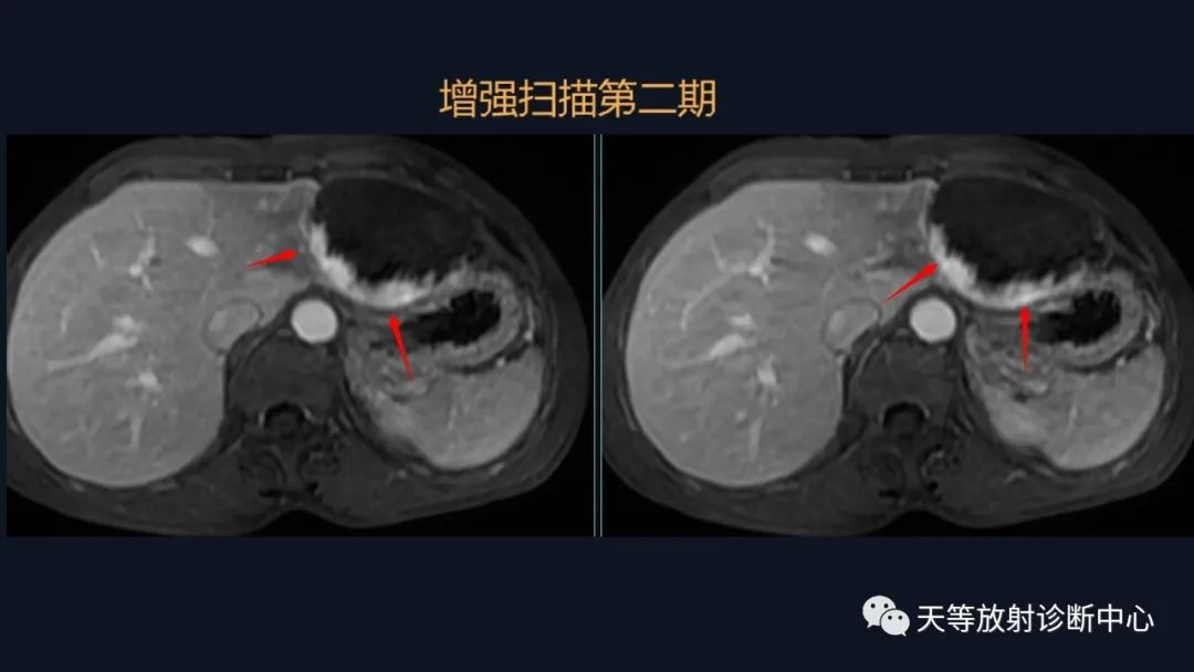 影像PPT - 带你认识灯泡征+早出晚归-15 影像PPT - 带你认识灯泡征+早出晚归-15