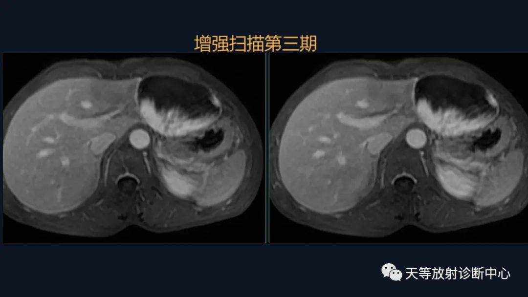 影像PPT - 带你认识灯泡征+早出晚归-19 影像PPT - 带你认识灯泡征+早出晚归-19