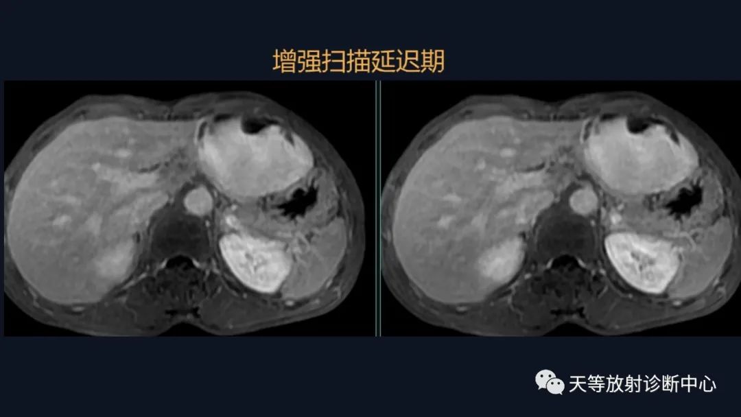 影像PPT - 带你认识灯泡征+早出晚归-22 影像PPT - 带你认识灯泡征+早出晚归-22