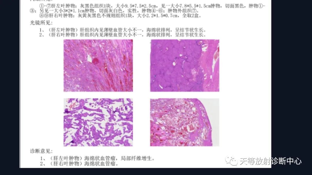 影像PPT - 带你认识灯泡征+早出晚归-29 影像PPT - 带你认识灯泡征+早出晚归-29