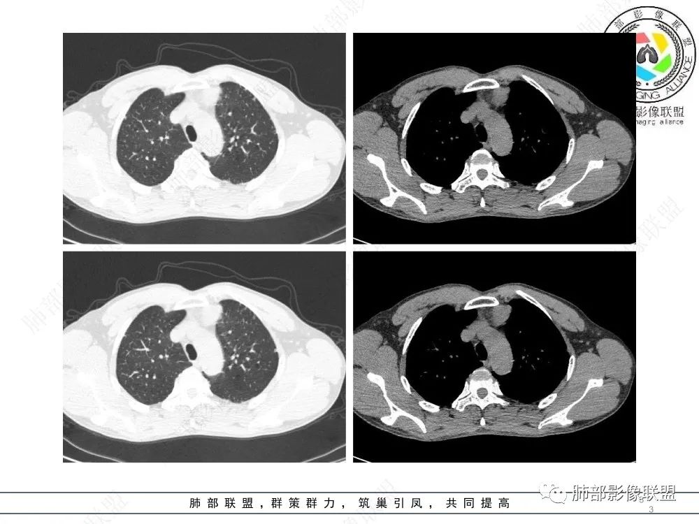 影像PPT - 【病例】前纵隔偏侧生长的肿块—胸腺瘤-3 影像PPT - 【病例】前纵隔偏侧生长的肿块—胸腺瘤-3