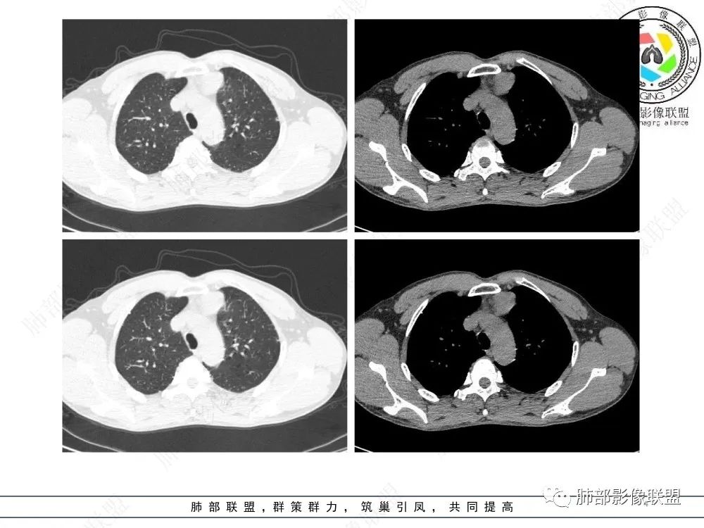 影像PPT - 【病例】前纵隔偏侧生长的肿块—胸腺瘤-4 影像PPT - 【病例】前纵隔偏侧生长的肿块—胸腺瘤-4