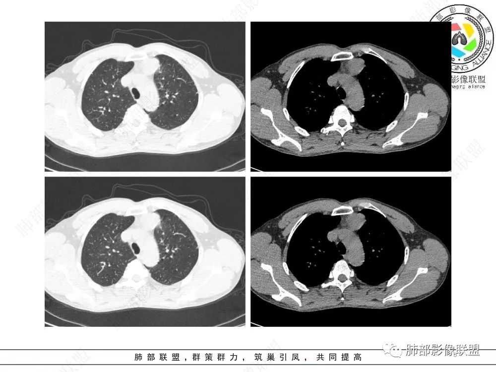 影像PPT - 【病例】前纵隔偏侧生长的肿块—胸腺瘤-5 影像PPT - 【病例】前纵隔偏侧生长的肿块—胸腺瘤-5