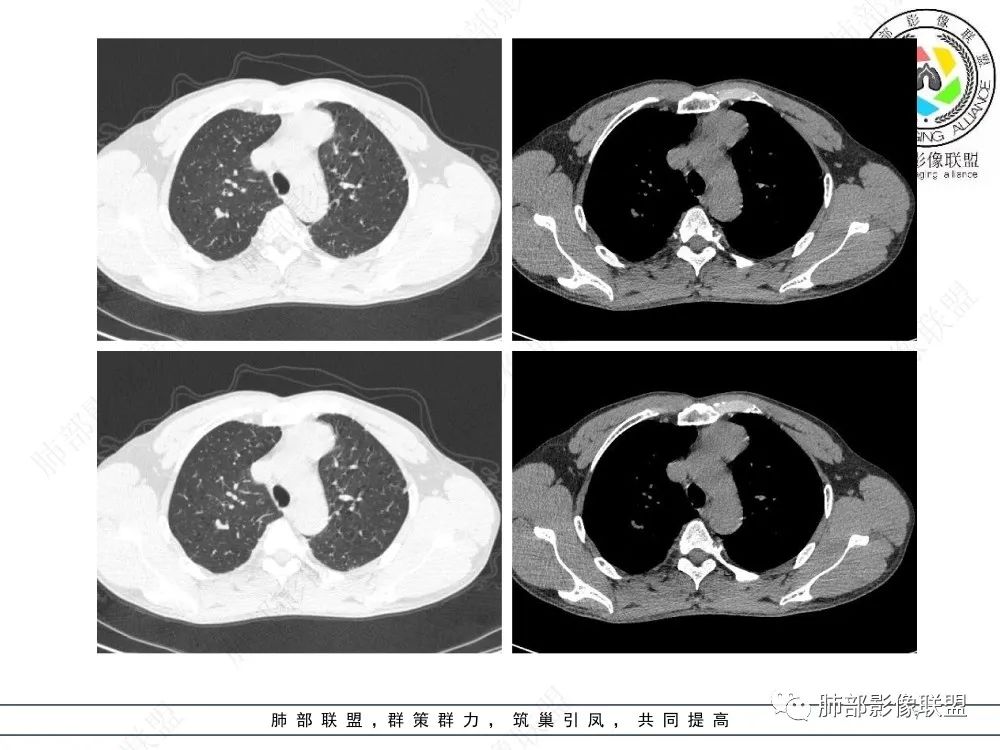 影像PPT - 【病例】前纵隔偏侧生长的肿块—胸腺瘤-7 影像PPT - 【病例】前纵隔偏侧生长的肿块—胸腺瘤-7