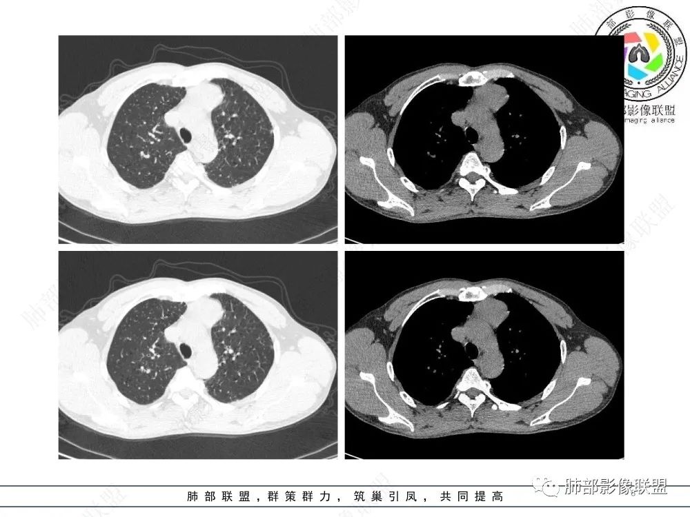 影像PPT - 【病例】前纵隔偏侧生长的肿块—胸腺瘤-8 影像PPT - 【病例】前纵隔偏侧生长的肿块—胸腺瘤-8