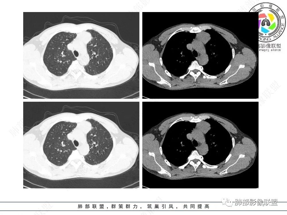 影像PPT - 【病例】前纵隔偏侧生长的肿块—胸腺瘤-9 影像PPT - 【病例】前纵隔偏侧生长的肿块—胸腺瘤-9