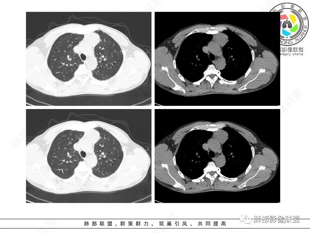影像PPT - 【病例】前纵隔偏侧生长的肿块—胸腺瘤-10 影像PPT - 【病例】前纵隔偏侧生长的肿块—胸腺瘤-10