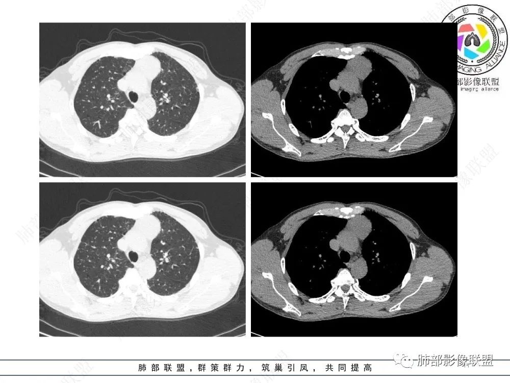 影像PPT - 【病例】前纵隔偏侧生长的肿块—胸腺瘤-11 影像PPT - 【病例】前纵隔偏侧生长的肿块—胸腺瘤-11
