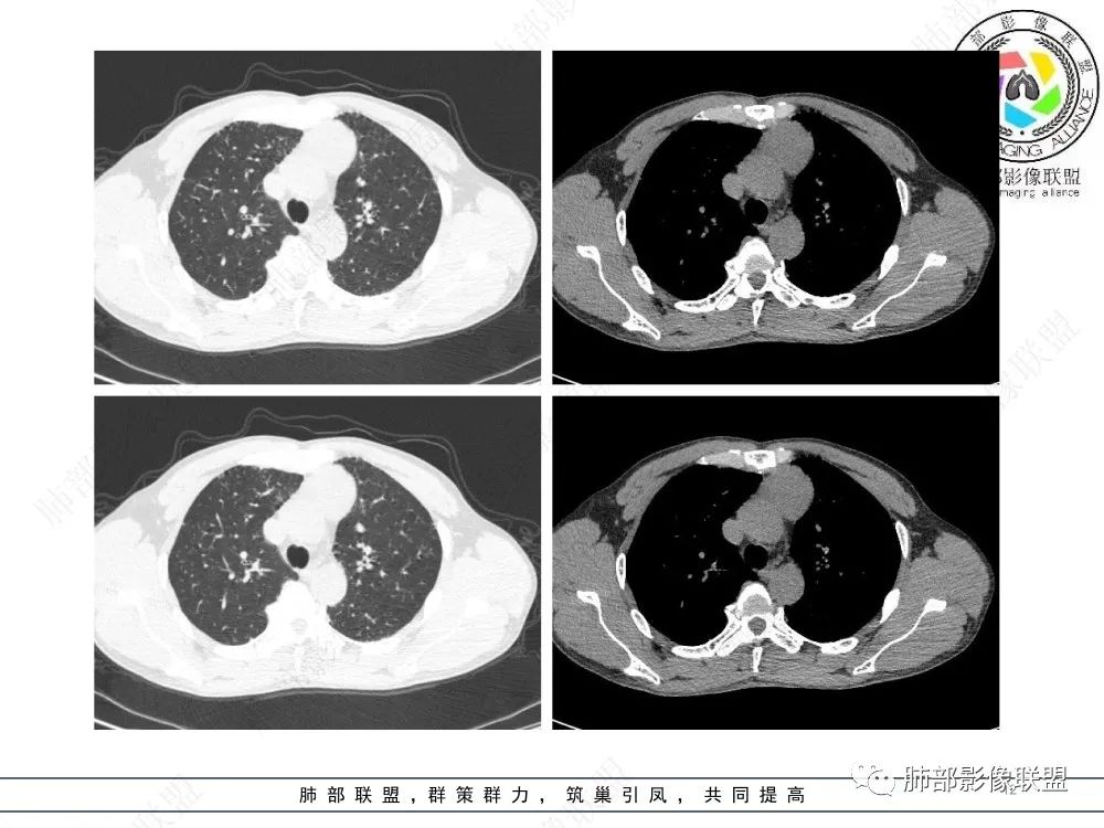 影像PPT - 【病例】前纵隔偏侧生长的肿块—胸腺瘤-12 影像PPT - 【病例】前纵隔偏侧生长的肿块—胸腺瘤-12