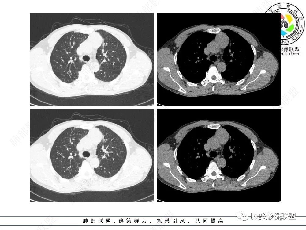 影像PPT - 【病例】前纵隔偏侧生长的肿块—胸腺瘤-15 影像PPT - 【病例】前纵隔偏侧生长的肿块—胸腺瘤-15