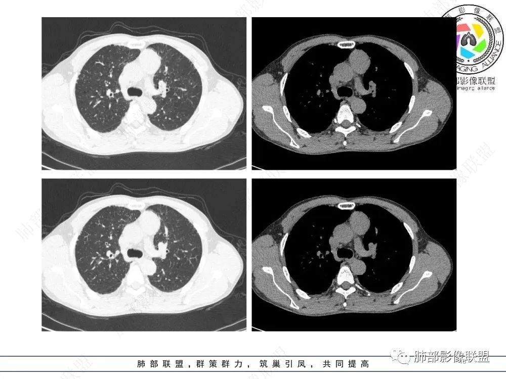 影像PPT - 【病例】前纵隔偏侧生长的肿块—胸腺瘤-18 影像PPT - 【病例】前纵隔偏侧生长的肿块—胸腺瘤-18