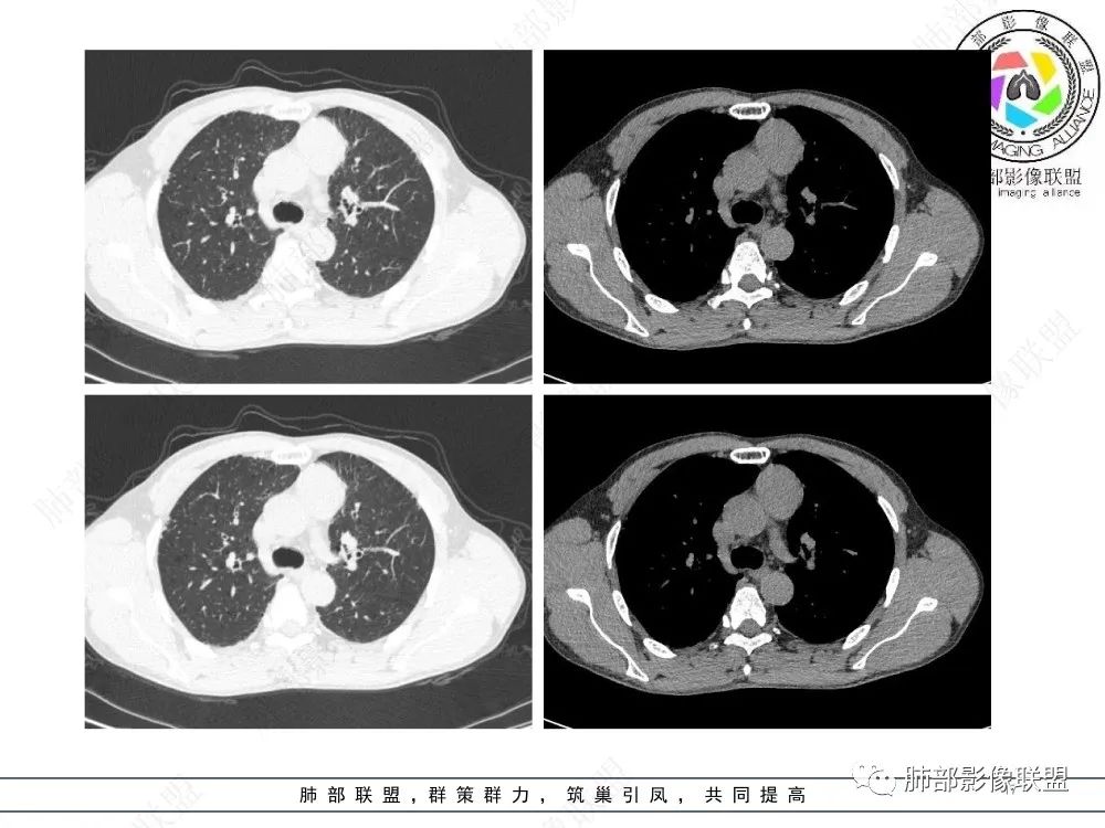 影像PPT - 【病例】前纵隔偏侧生长的肿块—胸腺瘤-17 影像PPT - 【病例】前纵隔偏侧生长的肿块—胸腺瘤-17