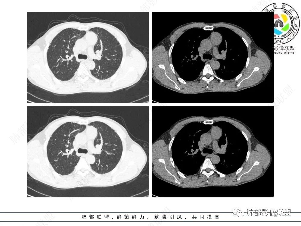 影像PPT - 【病例】前纵隔偏侧生长的肿块—胸腺瘤-19 影像PPT - 【病例】前纵隔偏侧生长的肿块—胸腺瘤-19