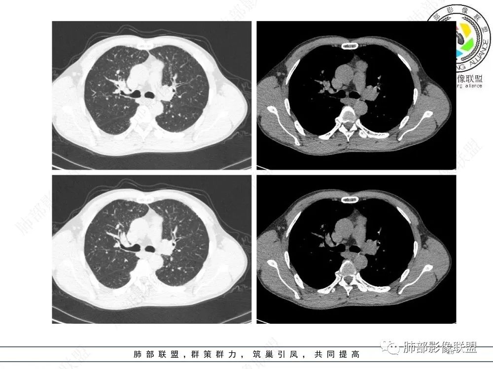 影像PPT - 【病例】前纵隔偏侧生长的肿块—胸腺瘤-23 影像PPT - 【病例】前纵隔偏侧生长的肿块—胸腺瘤-23