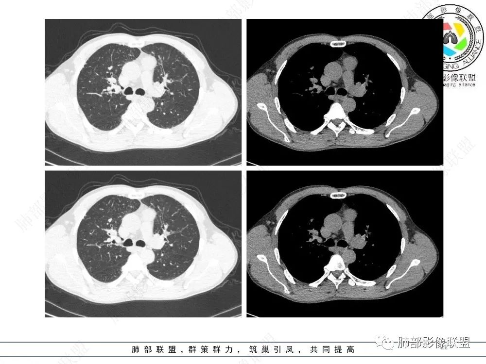 影像PPT - 【病例】前纵隔偏侧生长的肿块—胸腺瘤-22 影像PPT - 【病例】前纵隔偏侧生长的肿块—胸腺瘤-22