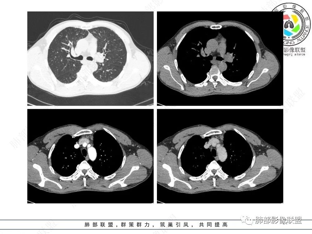 影像PPT - 【病例】前纵隔偏侧生长的肿块—胸腺瘤-24 影像PPT - 【病例】前纵隔偏侧生长的肿块—胸腺瘤-24