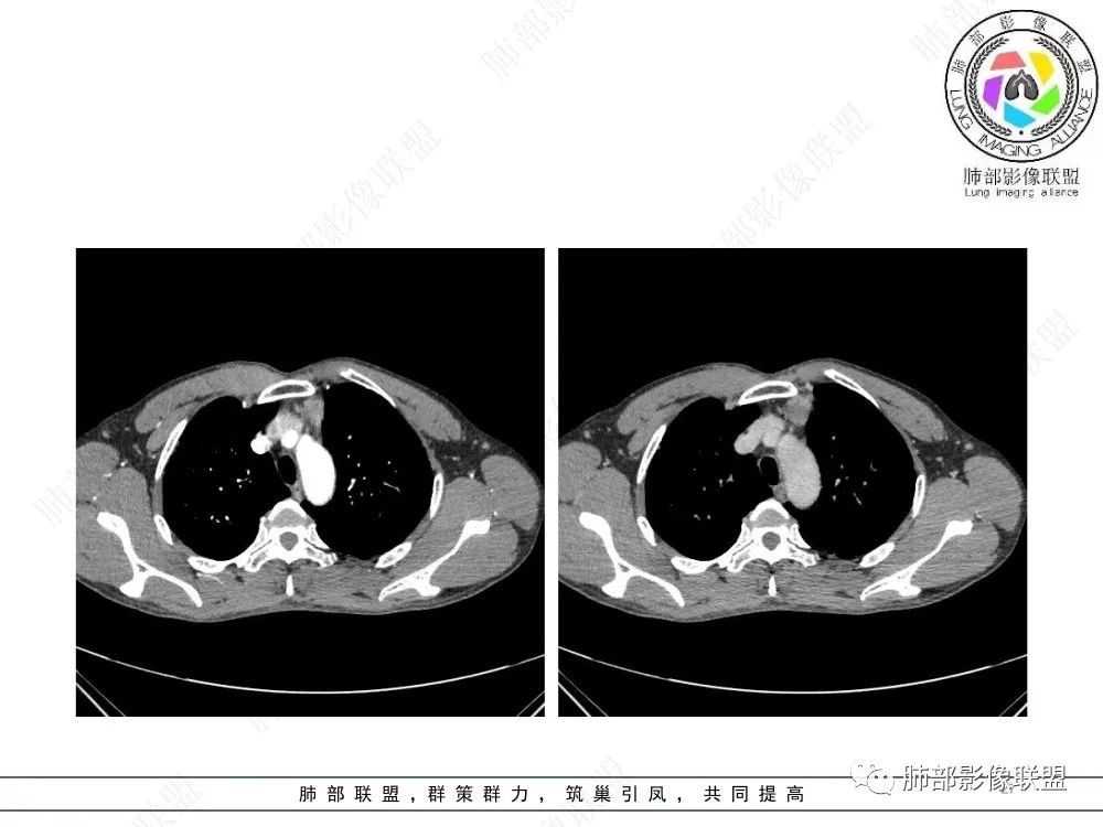 影像PPT - 【病例】前纵隔偏侧生长的肿块—胸腺瘤-27 影像PPT - 【病例】前纵隔偏侧生长的肿块—胸腺瘤-27