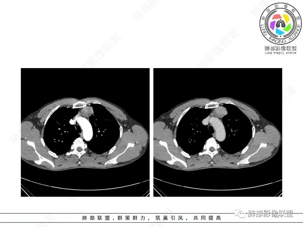影像PPT - 【病例】前纵隔偏侧生长的肿块—胸腺瘤-33 影像PPT - 【病例】前纵隔偏侧生长的肿块—胸腺瘤-33