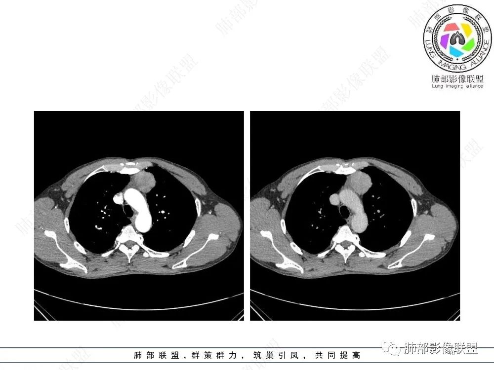 影像PPT - 【病例】前纵隔偏侧生长的肿块—胸腺瘤-40 影像PPT - 【病例】前纵隔偏侧生长的肿块—胸腺瘤-40