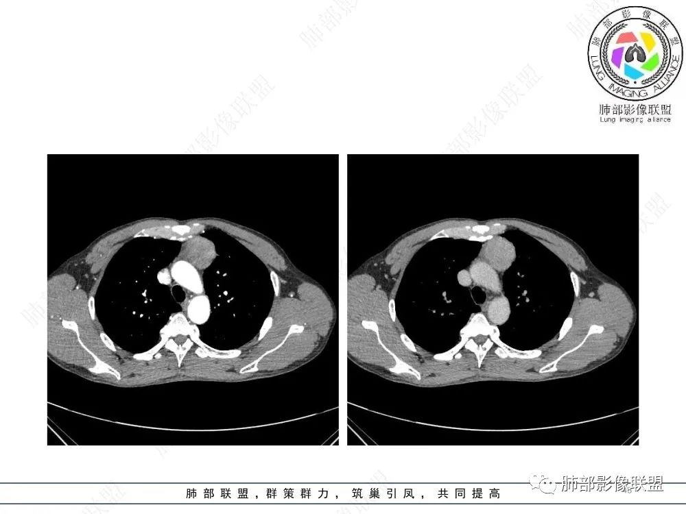 影像PPT - 【病例】前纵隔偏侧生长的肿块—胸腺瘤-43 影像PPT - 【病例】前纵隔偏侧生长的肿块—胸腺瘤-43