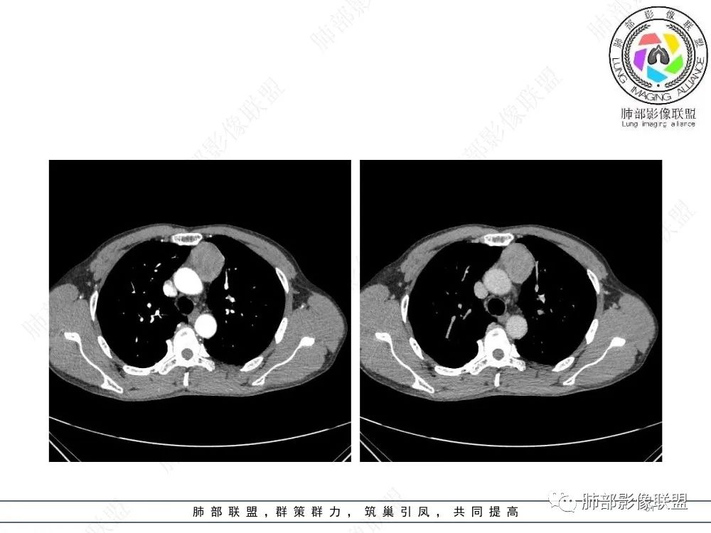 影像PPT - 【病例】前纵隔偏侧生长的肿块—胸腺瘤-51 影像PPT - 【病例】前纵隔偏侧生长的肿块—胸腺瘤-51