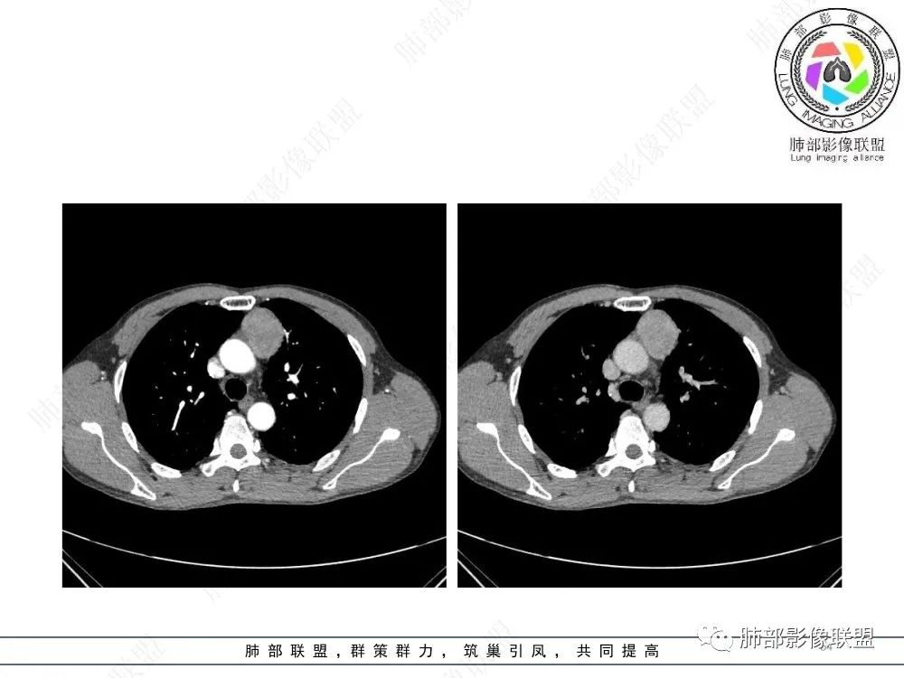 影像PPT - 【病例】前纵隔偏侧生长的肿块—胸腺瘤-54 影像PPT - 【病例】前纵隔偏侧生长的肿块—胸腺瘤-54