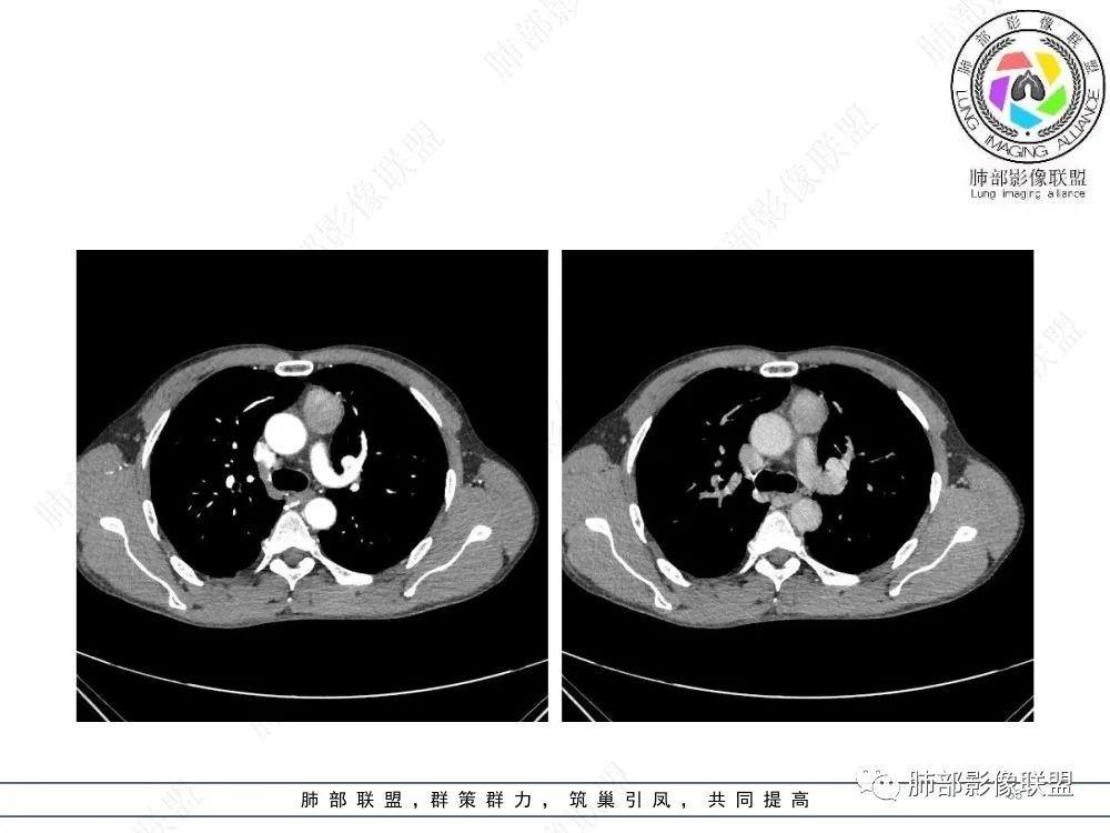 影像PPT - 【病例】前纵隔偏侧生长的肿块—胸腺瘤-63 影像PPT - 【病例】前纵隔偏侧生长的肿块—胸腺瘤-63