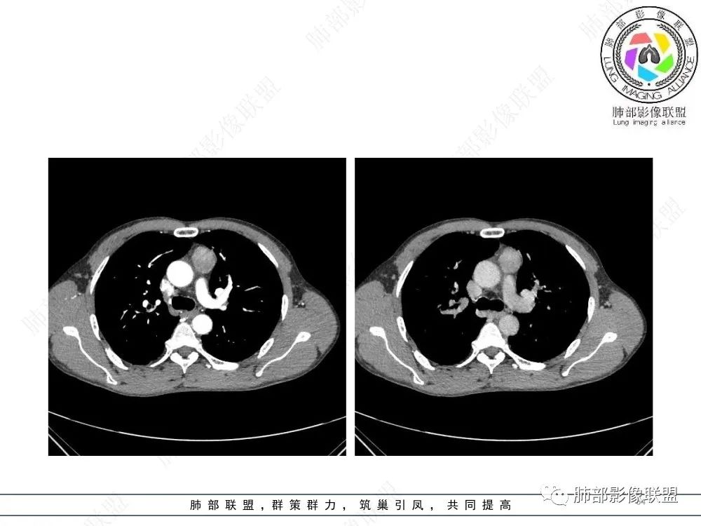 影像PPT - 【病例】前纵隔偏侧生长的肿块—胸腺瘤-64 影像PPT - 【病例】前纵隔偏侧生长的肿块—胸腺瘤-64