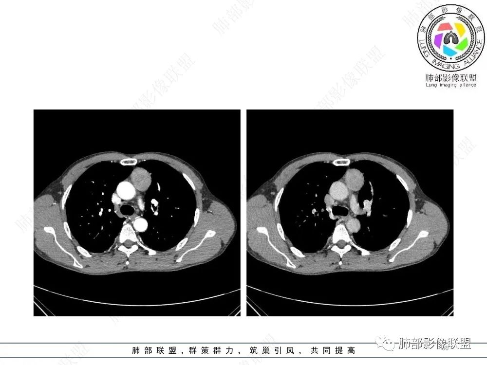 影像PPT - 【病例】前纵隔偏侧生长的肿块—胸腺瘤-60 影像PPT - 【病例】前纵隔偏侧生长的肿块—胸腺瘤-60