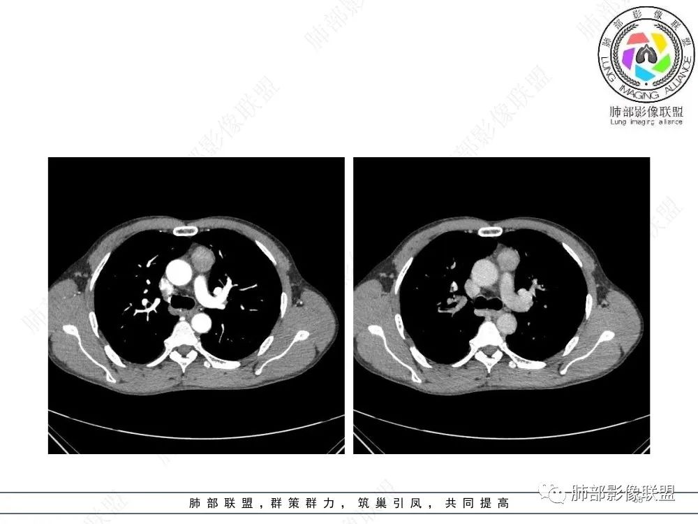 影像PPT - 【病例】前纵隔偏侧生长的肿块—胸腺瘤-65 影像PPT - 【病例】前纵隔偏侧生长的肿块—胸腺瘤-65