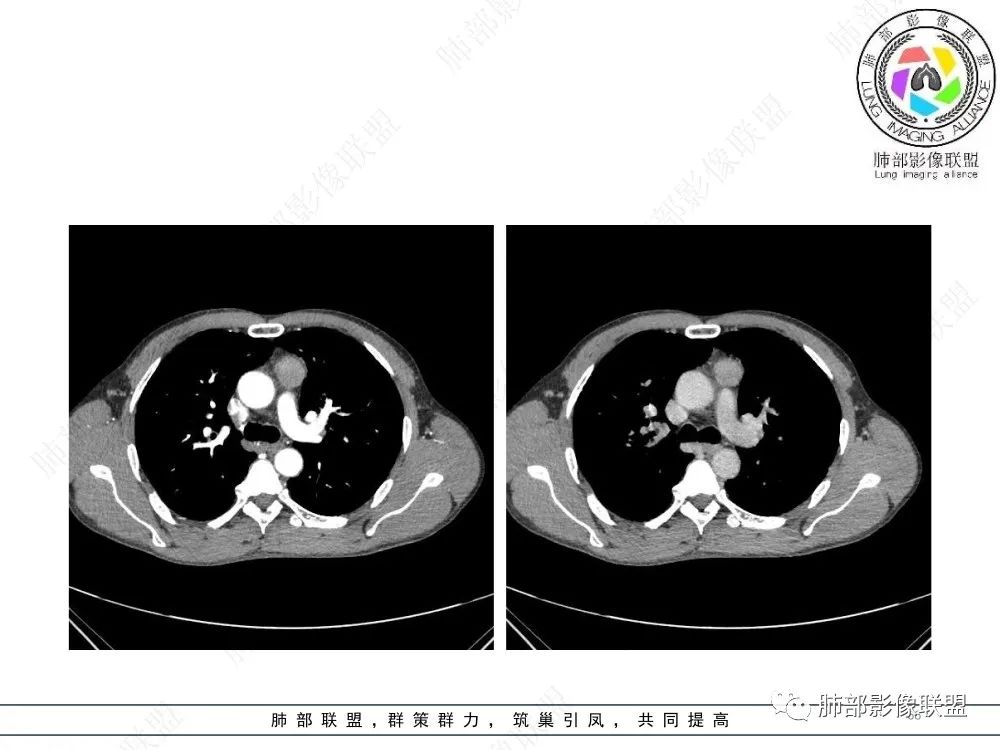 影像PPT - 【病例】前纵隔偏侧生长的肿块—胸腺瘤-66 影像PPT - 【病例】前纵隔偏侧生长的肿块—胸腺瘤-66