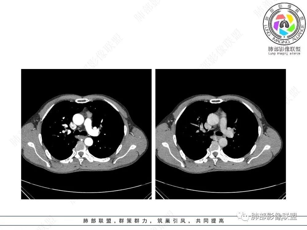 影像PPT - 【病例】前纵隔偏侧生长的肿块—胸腺瘤-70 影像PPT - 【病例】前纵隔偏侧生长的肿块—胸腺瘤-70