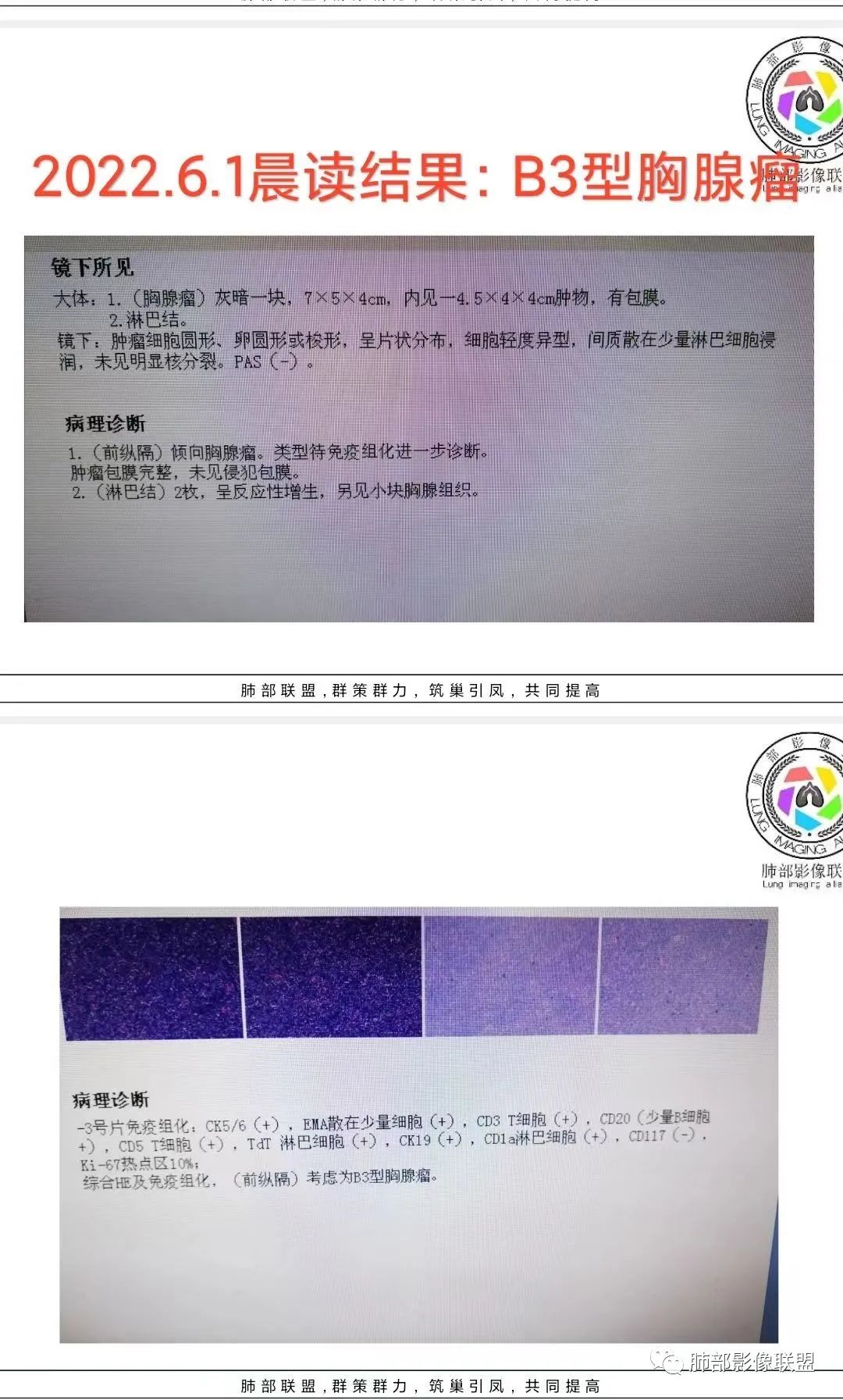 影像PPT - 【病例】前纵隔偏侧生长的肿块—胸腺瘤-73 影像PPT - 【病例】前纵隔偏侧生长的肿块—胸腺瘤-73