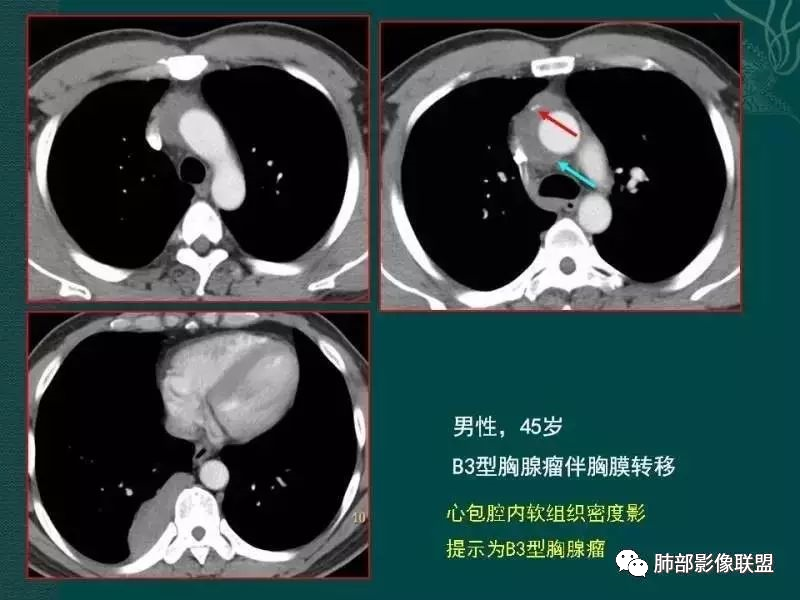 影像PPT - 【病例】前纵隔偏侧生长的肿块—胸腺瘤-76 影像PPT - 【病例】前纵隔偏侧生长的肿块—胸腺瘤-76