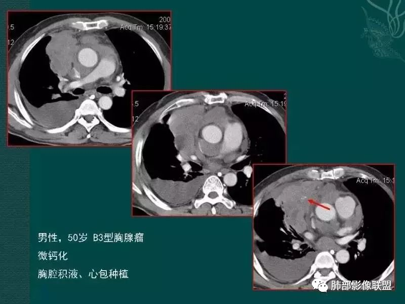 影像PPT - 【病例】前纵隔偏侧生长的肿块—胸腺瘤-77 影像PPT - 【病例】前纵隔偏侧生长的肿块—胸腺瘤-77