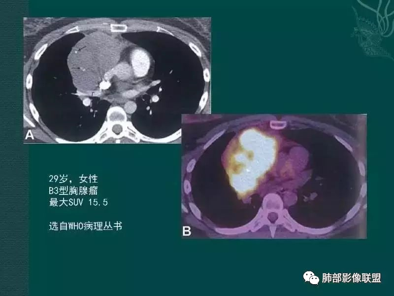 影像PPT - 【病例】前纵隔偏侧生长的肿块—胸腺瘤-78 影像PPT - 【病例】前纵隔偏侧生长的肿块—胸腺瘤-78