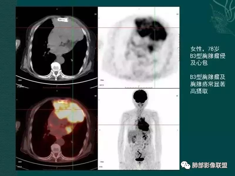 影像PPT - 【病例】前纵隔偏侧生长的肿块—胸腺瘤-79 影像PPT - 【病例】前纵隔偏侧生长的肿块—胸腺瘤-79