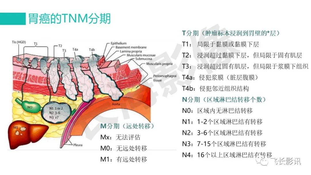 影像PPT - 【PPT】胃癌影像诊断的报告规范-5