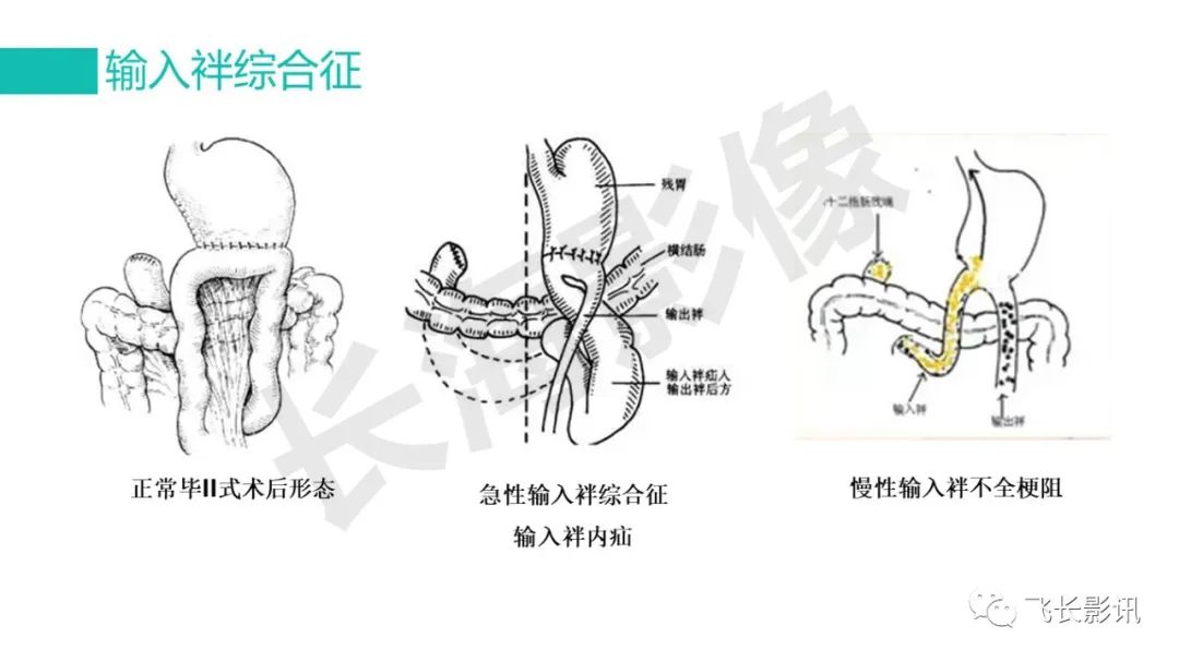 影像PPT - 【PPT】胃癌影像诊断的报告规范-13