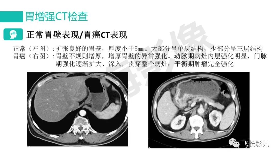 影像PPT - 【PPT】胃癌影像诊断的报告规范-20
