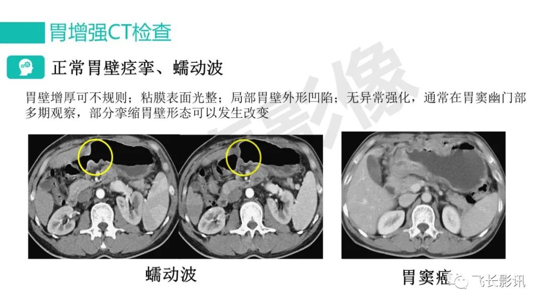 影像PPT - 【PPT】胃癌影像诊断的报告规范-21