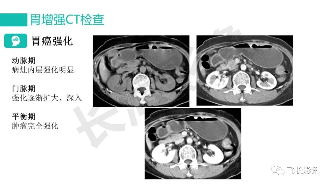 影像PPT - 【PPT】胃癌影像诊断的报告规范-22