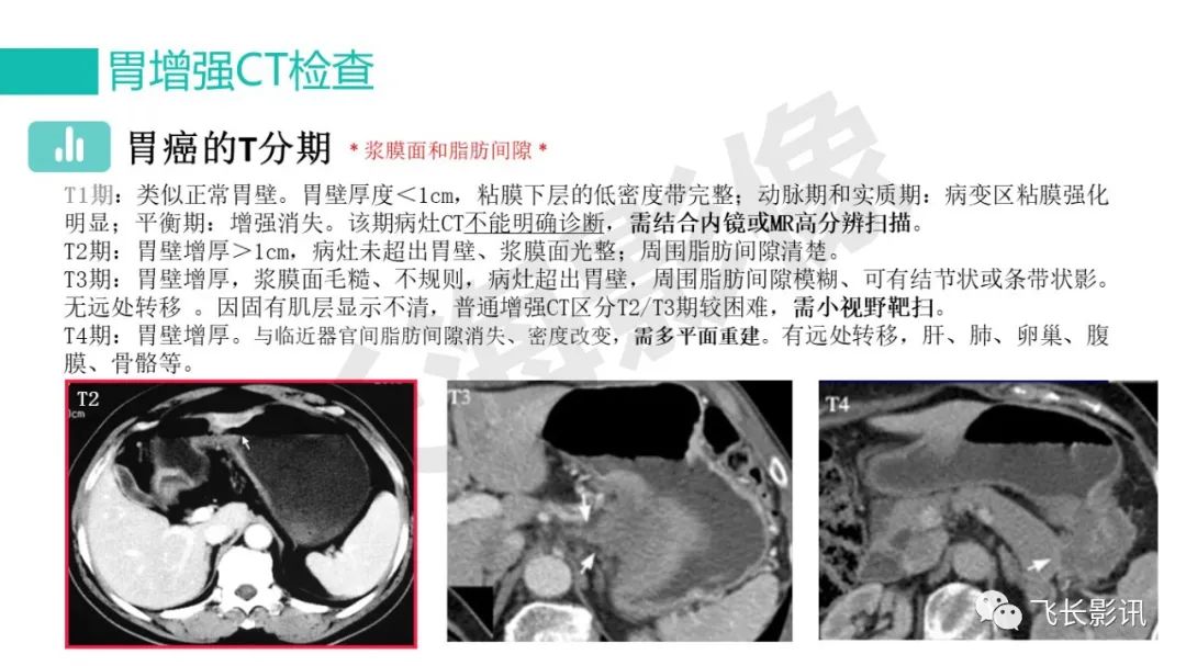 影像PPT - 【PPT】胃癌影像诊断的报告规范-23