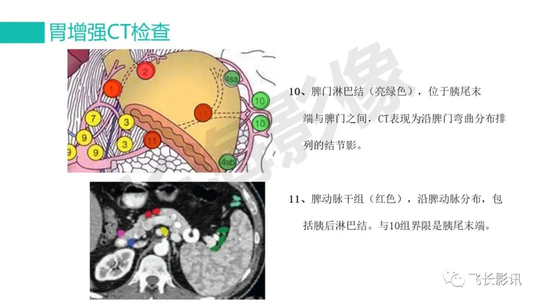 影像PPT - 【PPT】胃癌影像诊断的报告规范-30