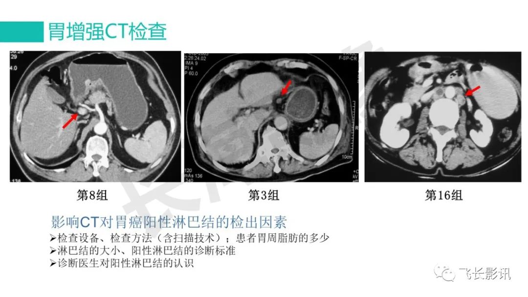 影像PPT - 【PPT】胃癌影像诊断的报告规范-33