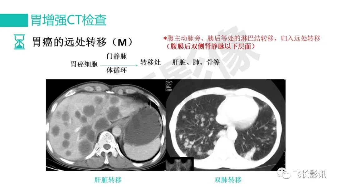 影像PPT - 【PPT】胃癌影像诊断的报告规范-34