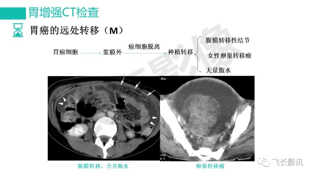 影像PPT - 【PPT】胃癌影像诊断的报告规范-35