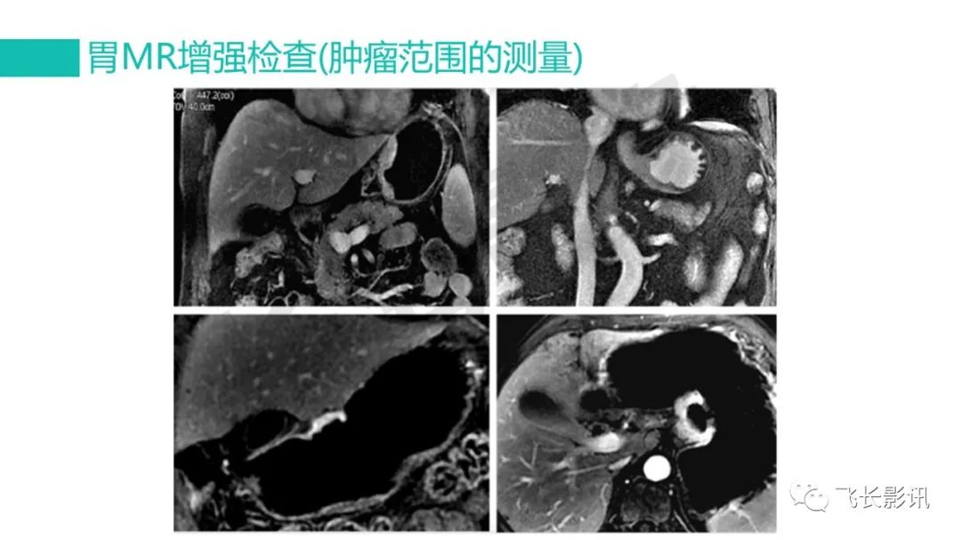 影像PPT - 【PPT】胃癌影像诊断的报告规范-38