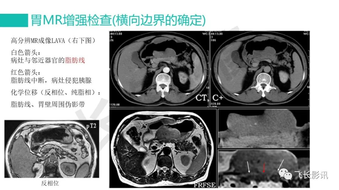 影像PPT - 【PPT】胃癌影像诊断的报告规范-39