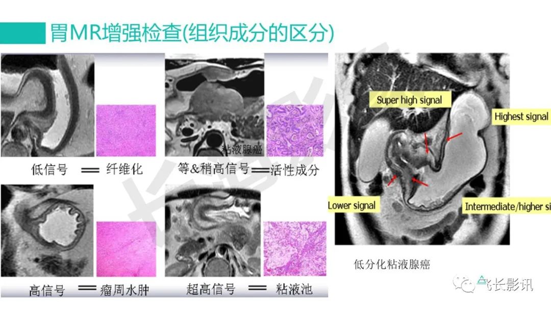 影像PPT - 【PPT】胃癌影像诊断的报告规范-40